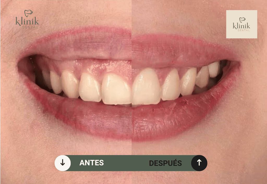 gingivectomia-madrid
