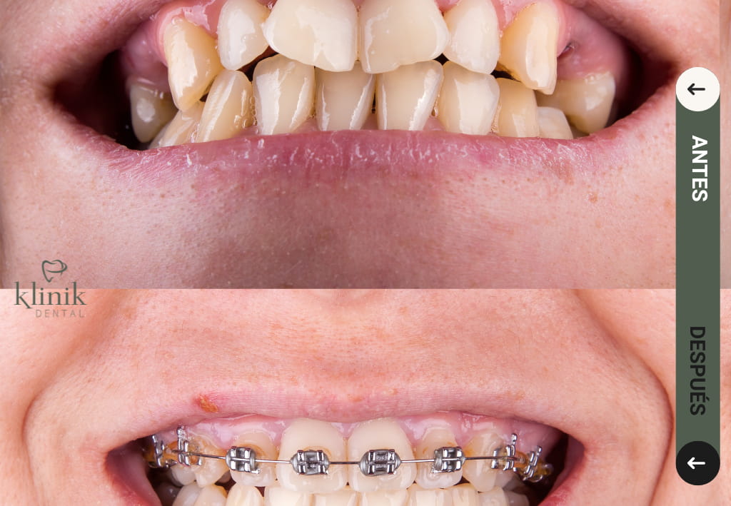 antes despues brackets metalicos madrid