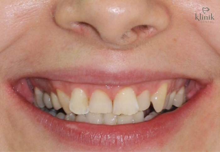 Antes