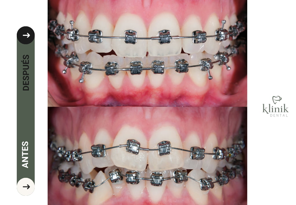 antes y despues barckets damon madrid