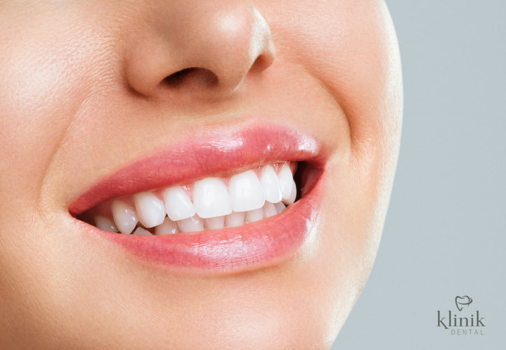 blanqueamiento dental en madrid