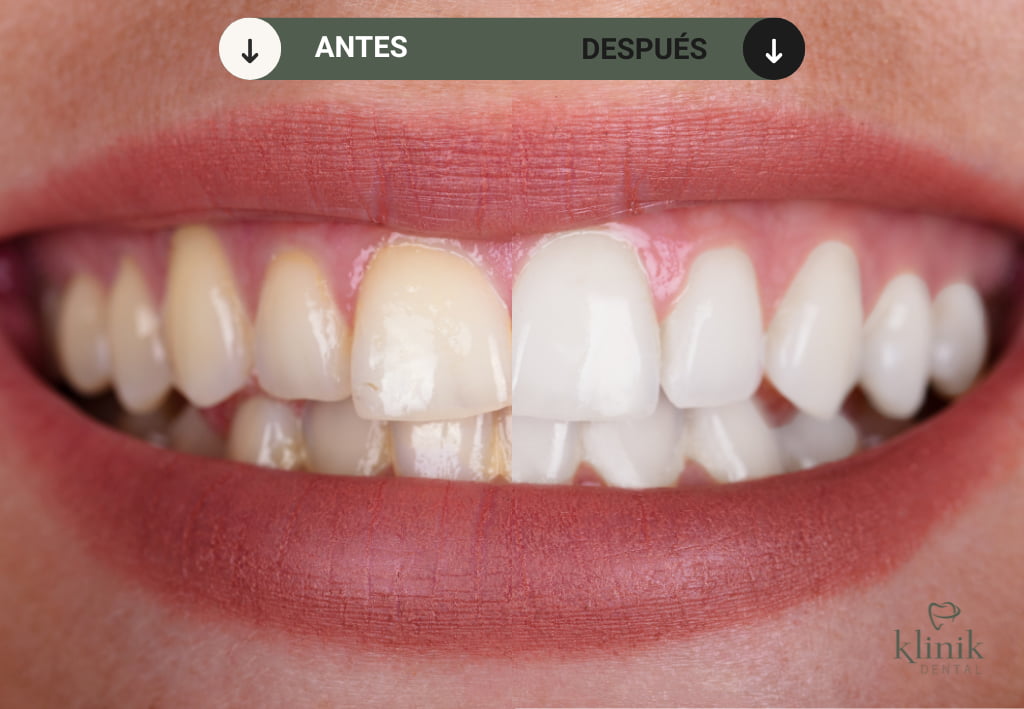 blanqueamiento dental madrid