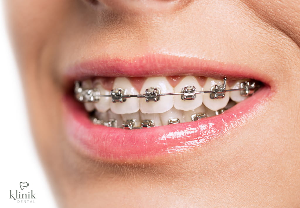 brackets damon madrid