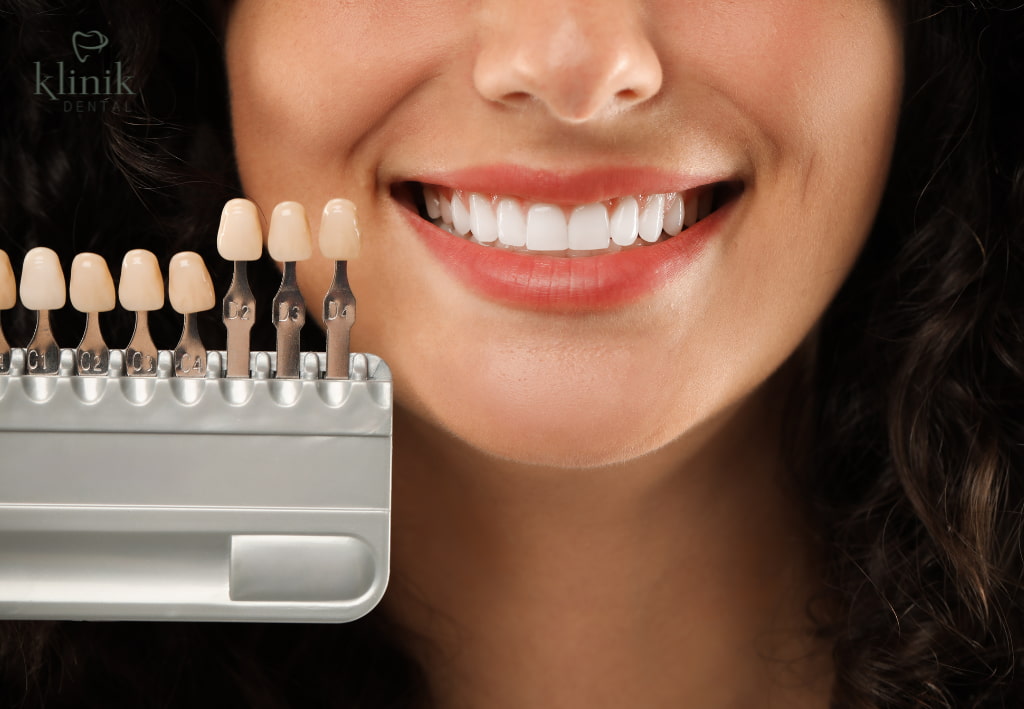 carillas dentales en madrid