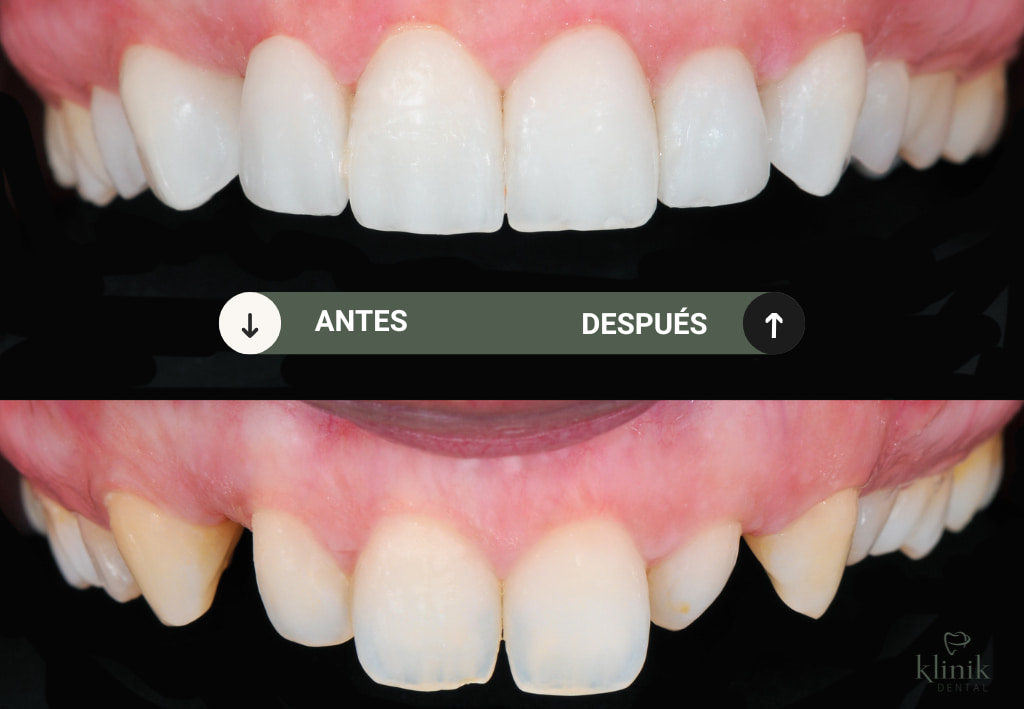 diseño de sonrisa madrid